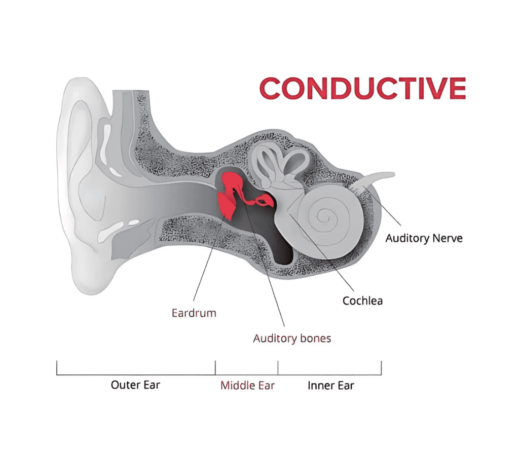 conductive hearing loss